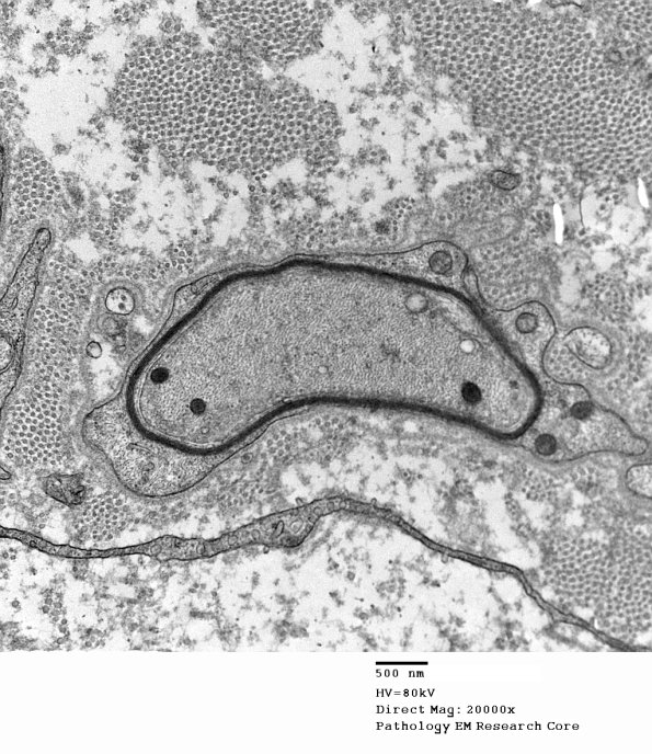 1F2 CIDP (Case 1) EM 036 - Copy