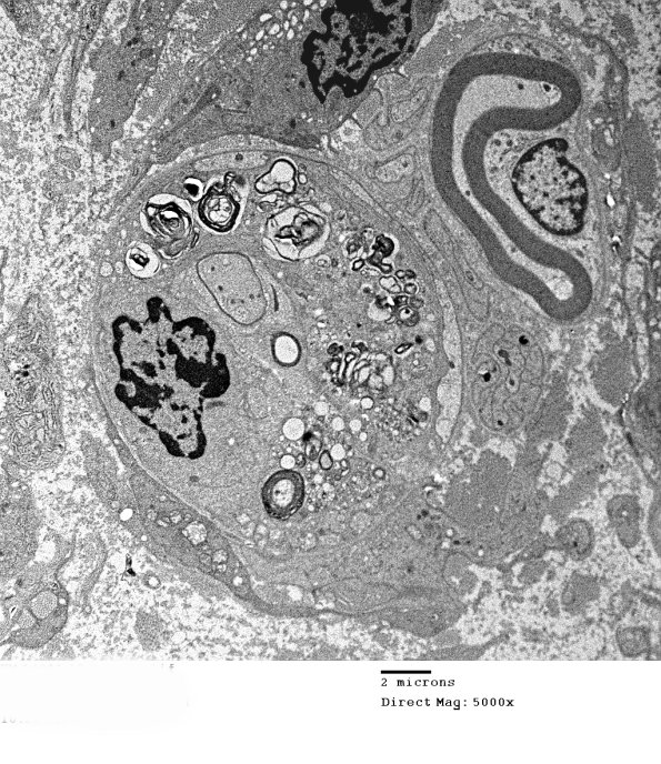 1G1A Case 1 A7 CIDP _011 - Copy