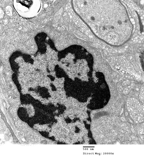 1G1B Case 1 A7 CIDP _013 - Copy