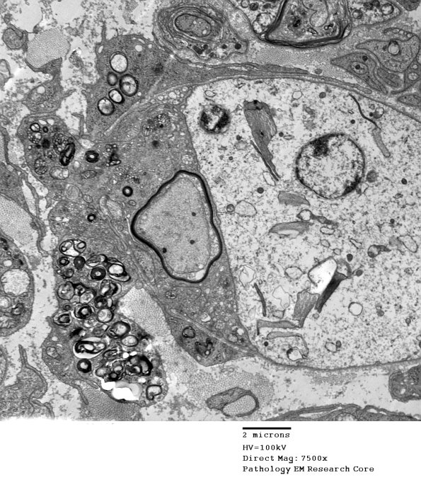 1G2A CIDP (Case 1)_030 - Copy