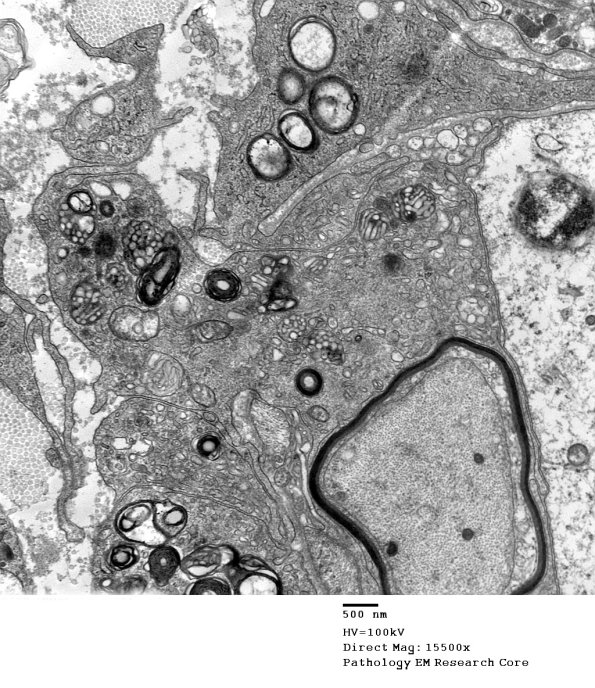 1G2B CIDP (Case 1)_031 - Copy