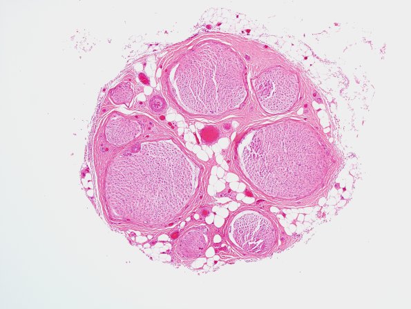 20A1 CIDP (Case 20) H&E 1