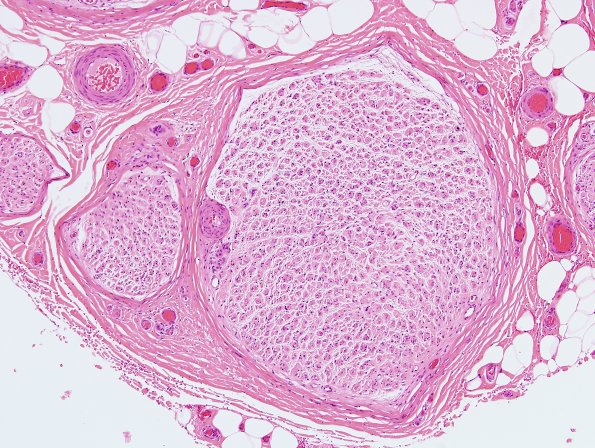 20A2 CIDP (Case 20) H&E 2