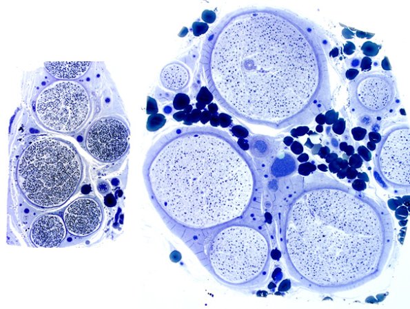 20B1 CIDP (Case 20) copy