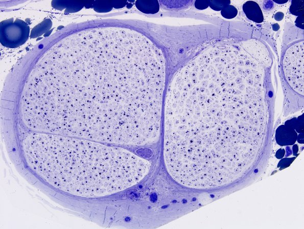 20B2 GBS, Chronic (Case 20)