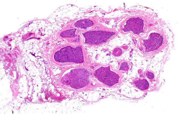 21A1 CIDP, fulminant (Case 21) H&E 4X