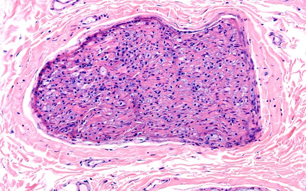 21A2 CIDP, fulminant (Case 21) H&E 20X