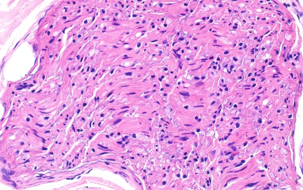 21A3 CIDP, fulminant (Case 21) H&E 40X 3