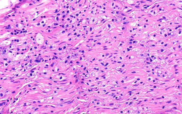 21A4 CIDP, fulminant (Case 21) H&E 40X 4