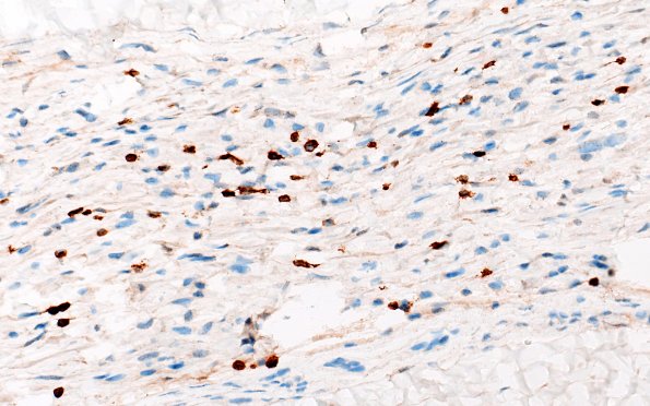 21B1B CIDP, fulminant (Case 21) CD3 40X 2