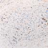 21B2 CIDP, fulminant (Case 21) CD3 40X 1