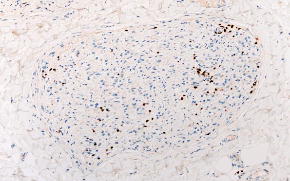 21B2 CIDP, fulminant (Case 21) CD3 40X 1