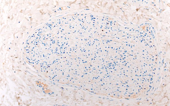 21C CIDP, fulminant (Case 21) CD20 40X 1