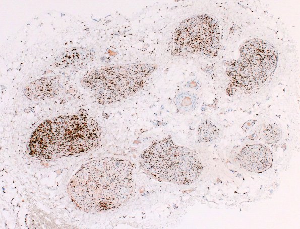 21D1A CIDP, fulminant (Case 21) CD68 4X 3