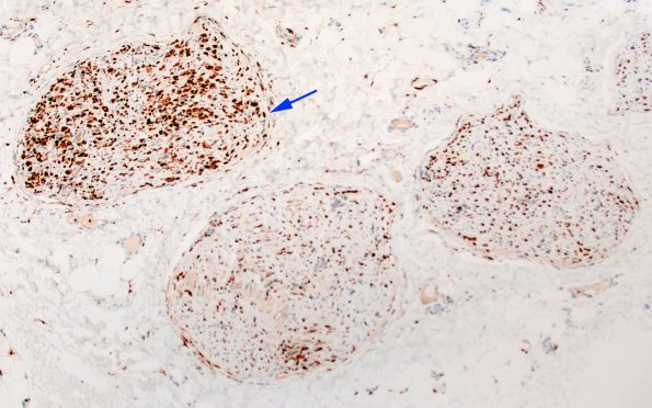 21D1B CIDP, fulminant (Case 21) CD68 10X 3 copy
