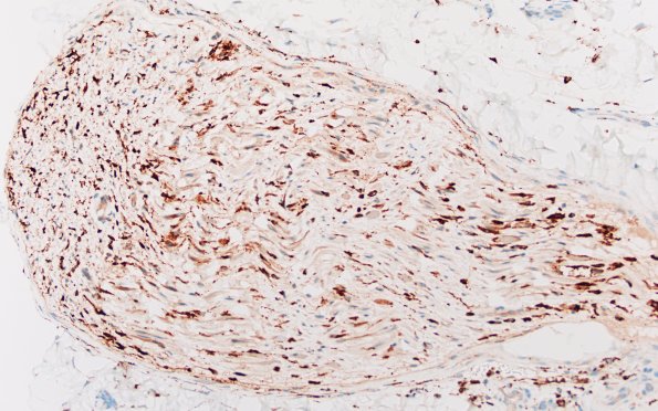 21D1C CIDP, fulminant (Case 21) CD68 20X 1
