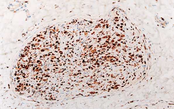 21D1D CIDP, fulminant (Case 21) CD68 20X 4