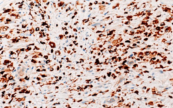 21D1E CIDP, fulminant (Case 21) CD68 40X 4