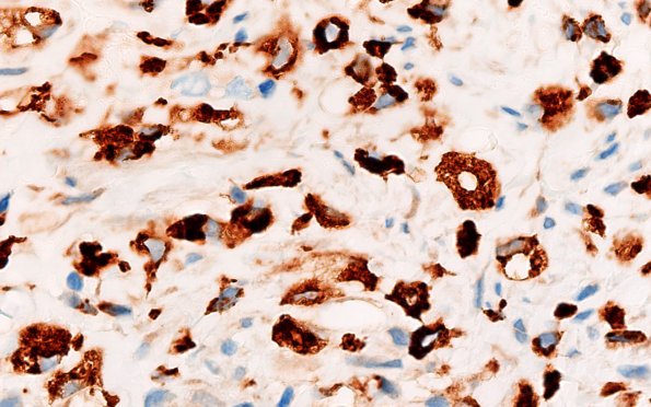 21D1F CIDP, fulminant (Case 21) CD68 100X 4
