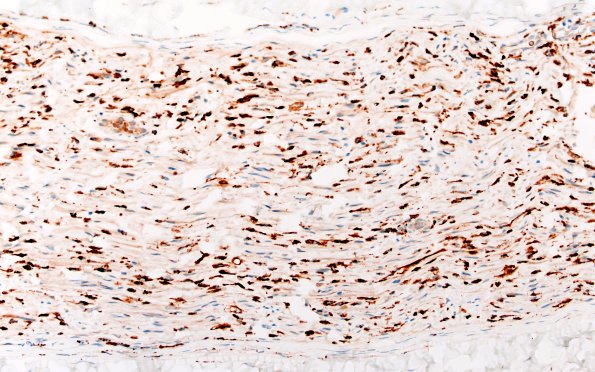 21D2 CIDP, fulminant (Case 21) CD68 40X 1