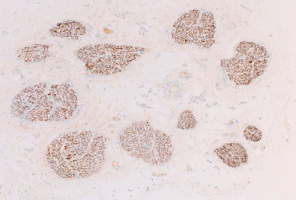 21E1 CIDP, fulminant (Case 21) NF 4X 2