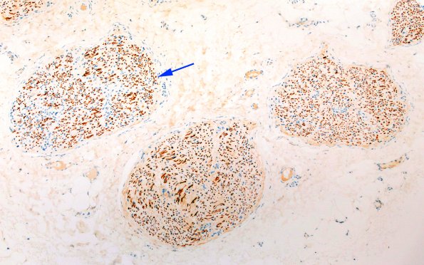 21E2 CIDP, fulminant (Case 21) NF 10X 2 copy