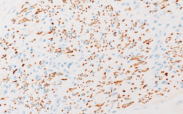 21E3 CIDP, fulminant (Case 21) NF 40X 3