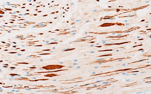 21E4 CIDP, fulminant (Case 21) NF 40X 1