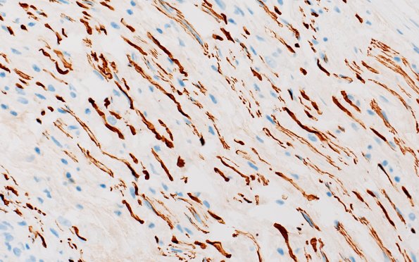 21E5 CIDP, fulminant (Case 21) NF 40X 2