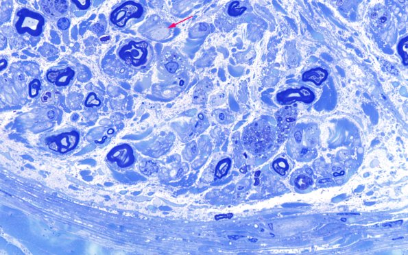 21F3E CIDP, fulminant (Case 21) Plastic A 100X 5 copy