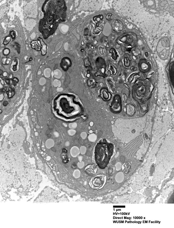 21J1B (Case 21) EM0107 focus - Copy