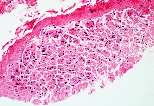 2A2 CIDP (Case 2) H&E 1.jpg