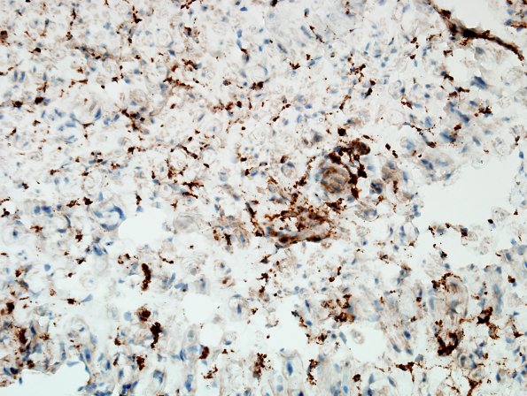 2B CIDP (Case 2) CD68 2.jpg