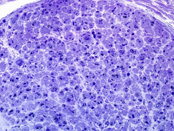 2C1 CIDP (Case 2) Plastic 5.jpg