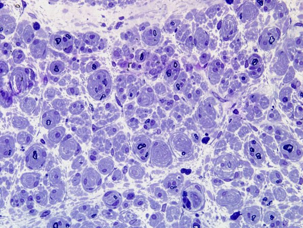 2C2 CIDP (Case 2) Plastic 1