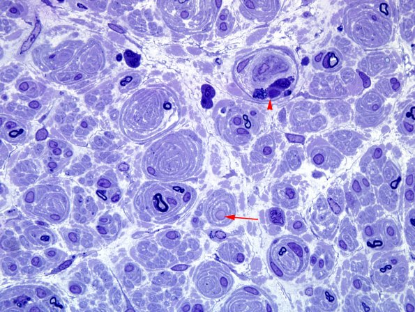 2C3 CIDP (Case 2) Plastic 10 copy.jpg