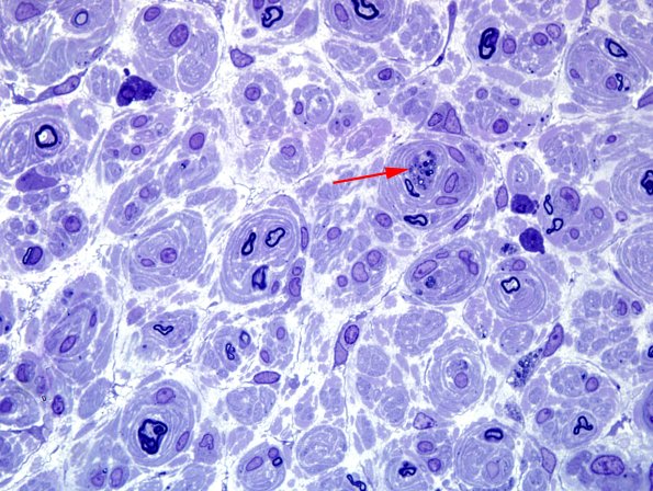 2C4 6CIDP (Case 2) Plastic 11 copy.jpg