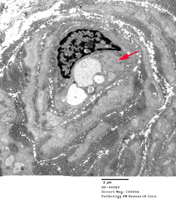 2D2 CIDP (Case 2) EM 078 copy.jpg
