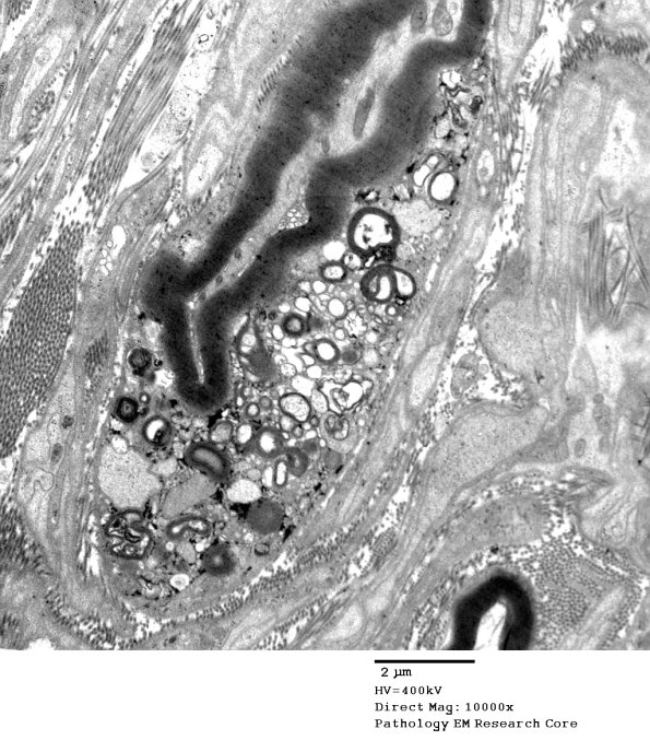 2D3 CIDP (Case 2) EM 080 - Copy