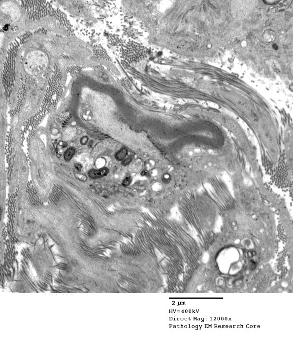 2D4 CIDP (Case 2) EM 096 - Copy