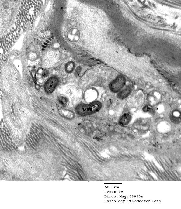 2D5 CIDP (Case 2) EM 093 - Copy