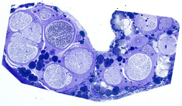 3A1 CIDP (Case 3) Plastic 4