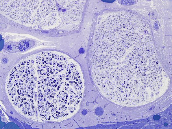 3A3 CIDP (Case 3) Plastic 1