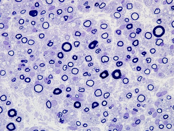 3A4 CIDP (Case 3) Plastic 100X 9