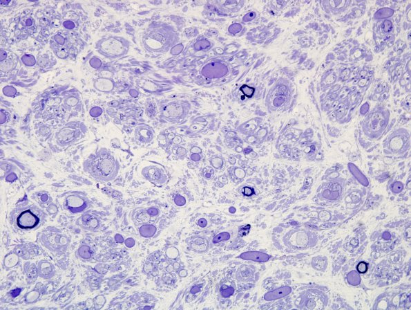 3A5 CIDP (Case 3) Plastic 100X 10