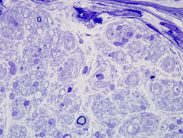 3A6 CIDP (Case 3) Plastic 100X 11