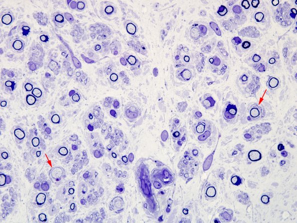 3A7 Fig 9-14 CIDP (Case 3) Plastic 100X 7 copy