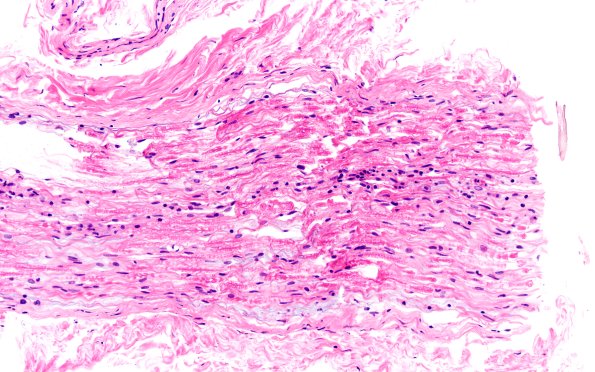 4A CIDP (Case 4) D Anterior Interosseus nerve H&E 20X