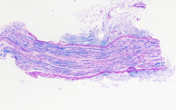 4B1 CIDP (Case 4) D Anterior Interosseus nerve LFB-PAS 10X