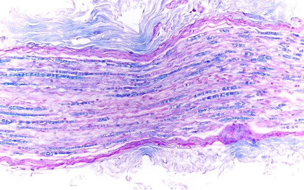 4B2 CIDP (Case 4) D Anterior Interosseus nerve LFB-PAS 20X